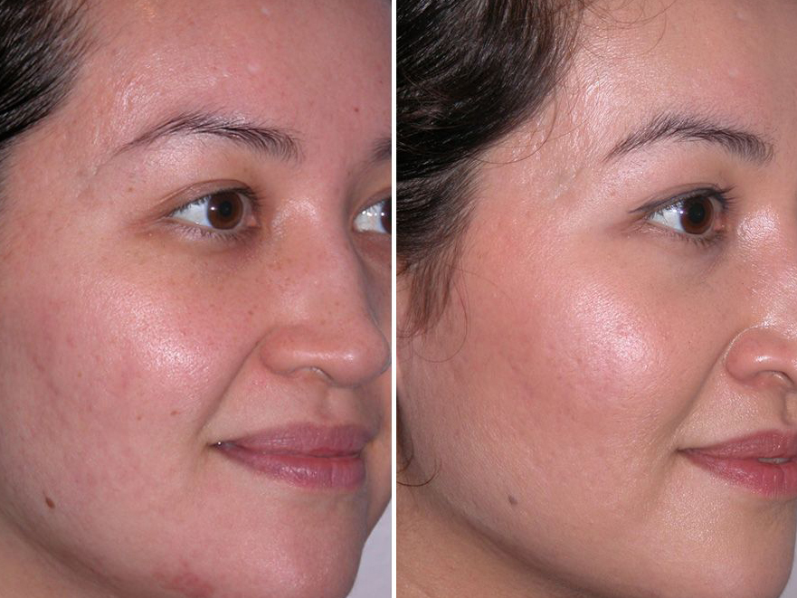 microdermabrasion avant-apres silhouetpeel