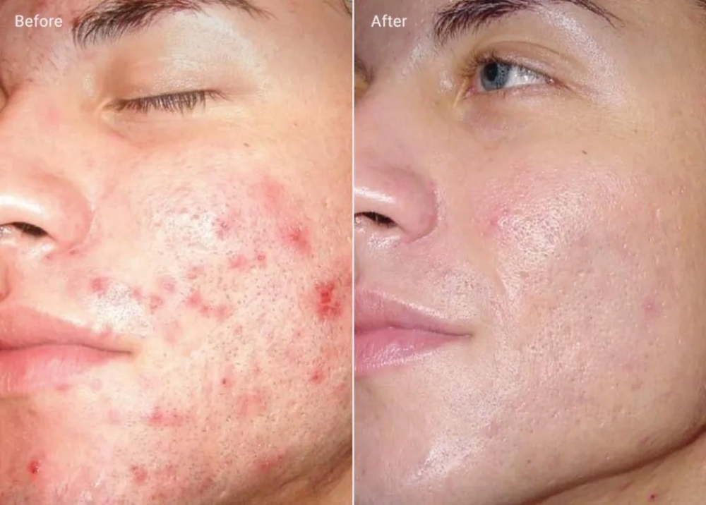 microdermabrasion avant-apres silhouetpeel